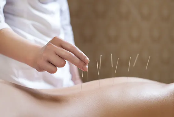 Acupuncture